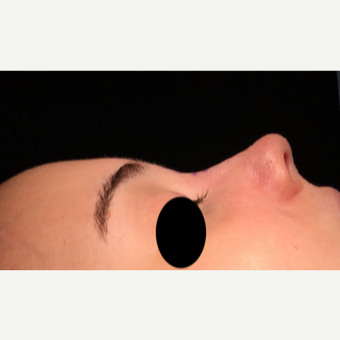 18-24 year old woman treated with Rhinoplasty after 3211246