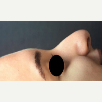 18-24 year old woman treated with Rhinoplasty before 3211246