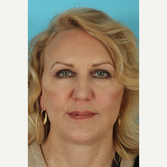 55-64 year old woman treated with Facelift after 3691411