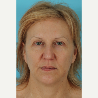 55-64 year old woman treated with Facelift before 3691411