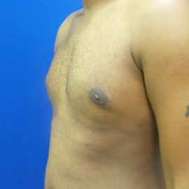 Male Breast Reduction after 3575525