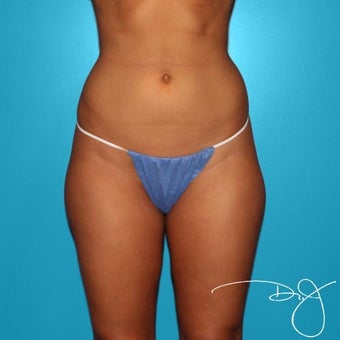 Liposuction of Flanks, Lower Abdomen and Thighs before 1190130
