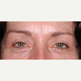 Surgical treatment with direct brow lift and blepharoplasty after 3042041