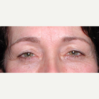 Surgical treatment with direct brow lift and blepharoplasty before 3042041