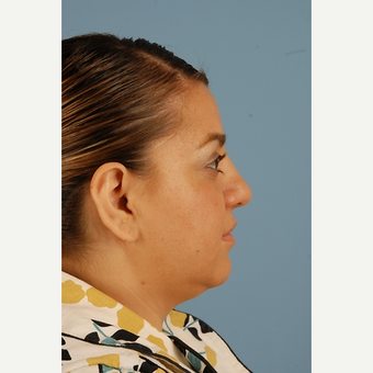 29 year old woman treated with Rhinoplasty before 3839762