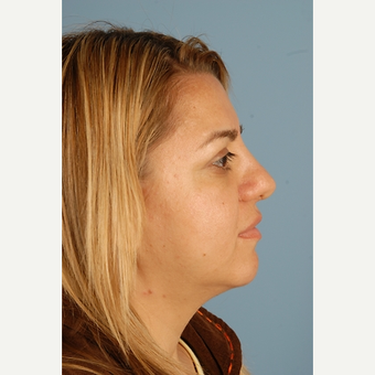 29 year old woman treated with Rhinoplasty after 3839762