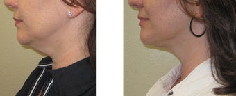 Chin liposuction/Liposculpture before 1007698
