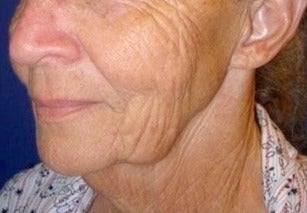Facelift, Necklift, Fractional CO2 Laser Skin Resurfacing before 3333280