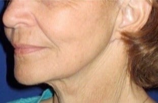 Facelift, Necklift, Fractional CO2 Laser Skin Resurfacing after 3333280