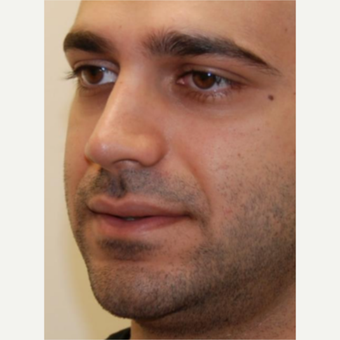 18-24 year old man treated with Rhinoplasty after 3143599
