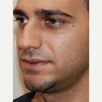 18-24 year old man treated with Rhinoplasty before 3143599