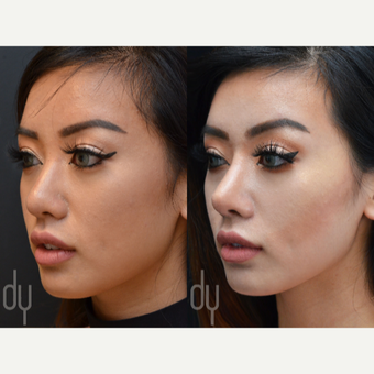 Asian Rhinoplasty with Rib cartilage before 3739401