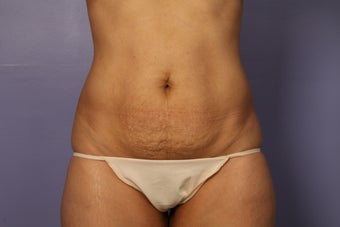 Tummy Tuck before 687597