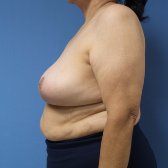 65-74 year old woman treated with Breast Reduction after 3087410