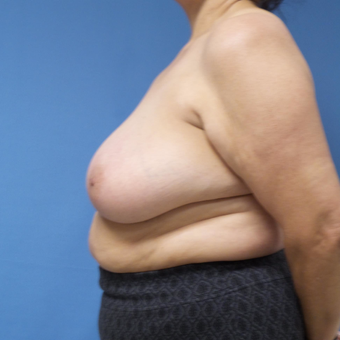 65-74 year old woman treated with Breast Reduction before 3087410