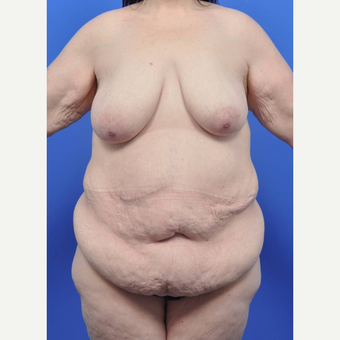 35-44 year old woman treated with Body Lift before 3455671