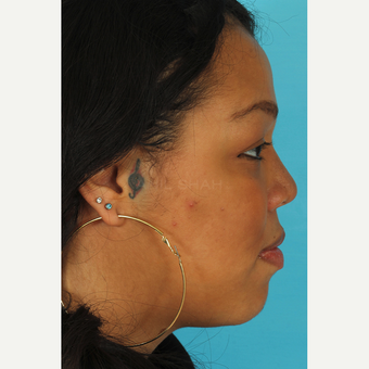 25-34 year old woman treated with Rhinoplasty after 3628942