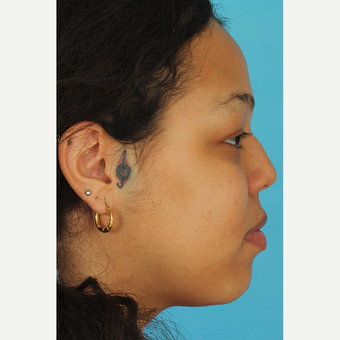 25-34 year old woman treated with Rhinoplasty before 3628942