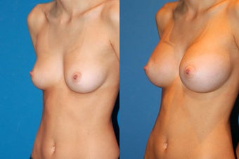 Breast Augmentation after 229356