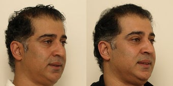 Septoplasty with nose reshaping after 1011546
