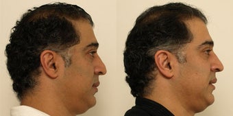 Septoplasty with nose reshaping before 1011546