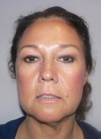 49 year old woman has Mini Facelift before 975658