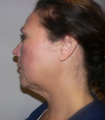 49 year old woman has Mini Facelift 975658