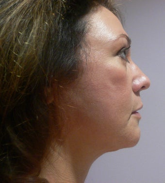 49 year old woman has Mini Facelift 975658
