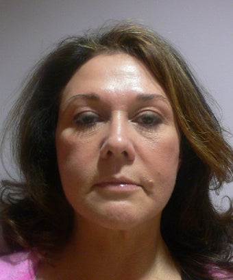 49 year old woman has Mini Facelift after 975658