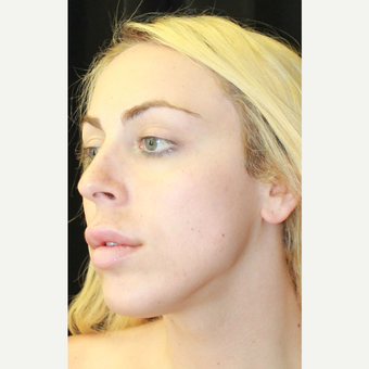 18-24 year old woman treated with Jaw Reduction before 3741927