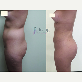 18-24 year old woman treated with Brazilian Butt Lift after 3538793