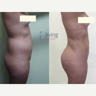 18-24 year old woman treated with Brazilian Butt Lift before 3538793