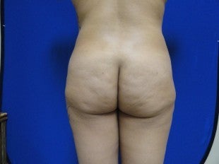 38 year old Brazilian Butt Lift before 1069864