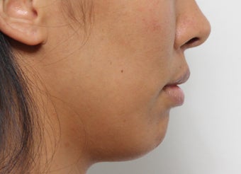 Lip Lift Procedure 3490440