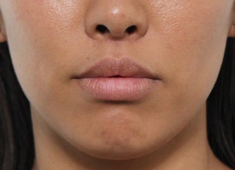 Lip Lift Procedure after 3490440