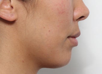 Lip Lift Procedure 3490440