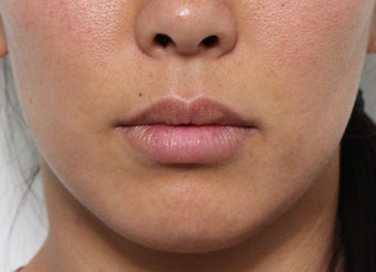 Lip Lift Procedure before 3490440