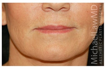 Fat Grafting after 1198836