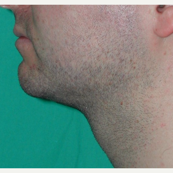 25-34 year old man treated with Liposuction after 3245933
