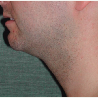 25-34 year old man treated with Liposuction before 3245933