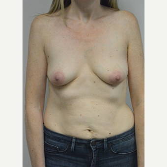 35-44 year old woman treated with Breast Implants before 3304583
