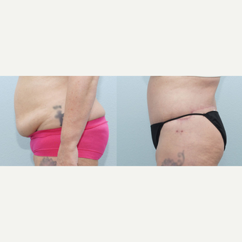 56 yr old Female - Body Lift after 3099786