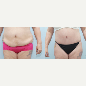 56 yr old Female - Body Lift before 3099786