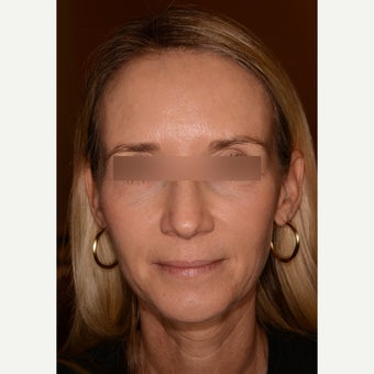 Full facial rejuvenation with Voluma and Juvederm Ultra Plus XC after 1597923