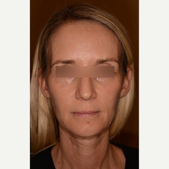 Full facial rejuvenation with Voluma and Juvederm Ultra Plus XC before 1597923