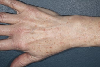 Hand Rejuvenation - fat injection and photo rejuvenation before 1171430