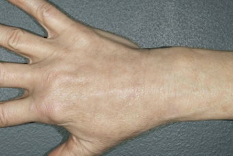 Hand Rejuvenation - fat injection and photo rejuvenation after 1171430