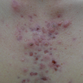 Acne scars on the chest can be treated with multiple treatment options before 3719721