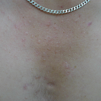 Acne scars on the chest can be treated with multiple treatment options after 3719721