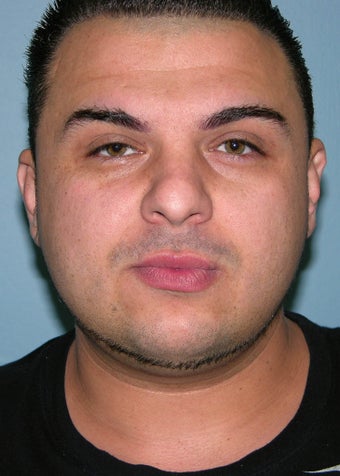 Male Rhinoplasty 1374785